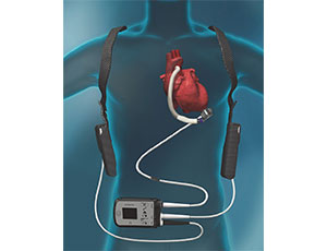 Herzpumpe oder Left-Ventricular Assist Device (LVAD) HeartMate 3™
